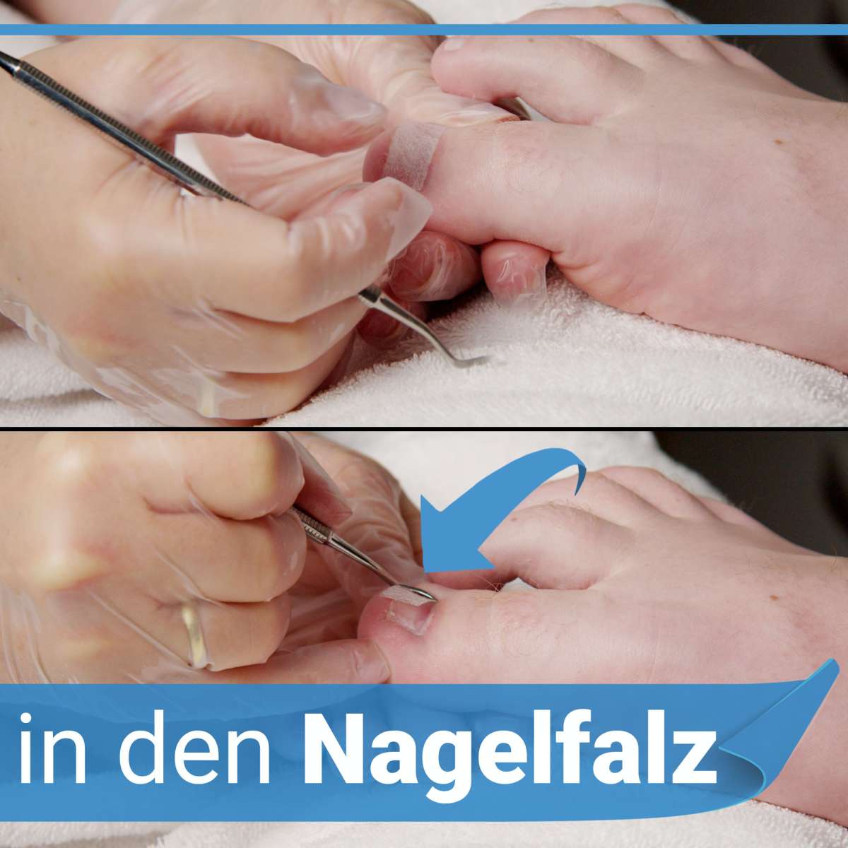 Kosmetex Set Gegen Eingewachsene Nägel – Mit Wattehaken, Tamponade, Zehenbinde & Salbe, 7-teilig